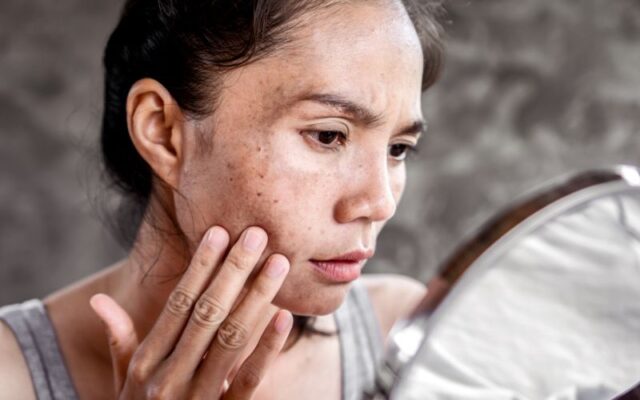 Da bị nám có thể điều trị khỏi hoàn toàn?