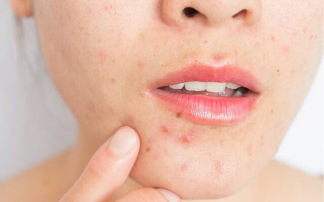 Ngưng chăm sóc da sau khi hết mụn?