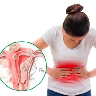 U xơ tử cung, nguyên nhân và triệu chứng