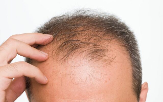 Đàn ông hói đầu có phải liên quan đến vấn đề sinh lý?