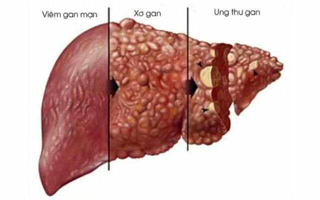 Rượu bia hủy hoại gan thế nào?